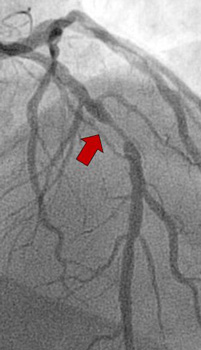 Intra Conditions And Diseases Interventional Cardiology Coronary Artery Stenosis